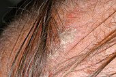 Psoriasis on a man's scalp