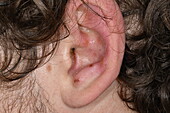 Blisters in ear of male patient