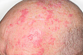 Shingles rash affecting a man's scalp