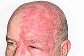 Shingles rash affecting a man's face