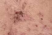 Healing scabs from shingles rash