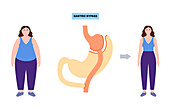 Gastric bypass surgery, illustration