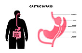 Gastric bypass surgery, illustration