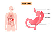 Gastric bypass surgery, illustration