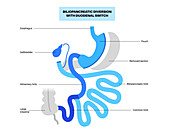 Biliopancreatic diversion procedure, illustration