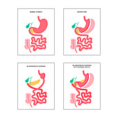 Types of bariatric surgery, illustration