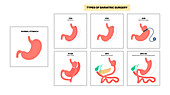 Types of bariatric surgery, illustration