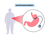Gastric band medical procedure, illustration