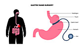 Gastric band medical procedure, illustration