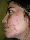 Acne that is worsening with treatmet