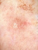 Recurrent basal cell carcinoma, dermoscopy