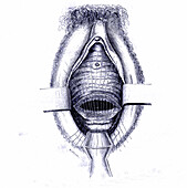 Vesicovaginal fistula treatment, 19th century illustration