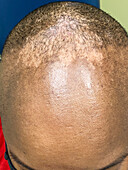 Seborrheic dermatitis and alopecia