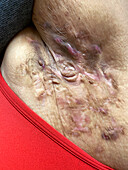 Hidradenitis suppurativa