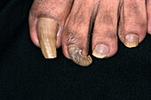 Deformed toenails