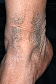 Terra-firma forme dermatosis