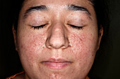 Skin lesions in tuberous sclerosis