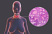 Toxic goitre of thyroid gland, 3D illustration