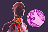 Toxic goitre of thyroid gland, 3D illustration