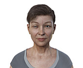 Woman with Horner syndrome, illustration