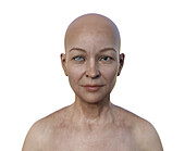Woman with anisocoria, illustration