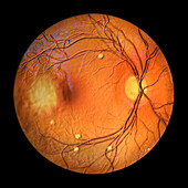 Retina affected by blastomycosis, illustration