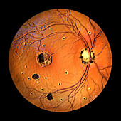 Retina affected by ocular histoplasmosis syndrome, illustration