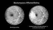 Retina affected by blastomycosis, illustration