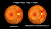 Retina affected by ocular histoplasmosis syndrome, illustration