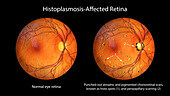 Retina affected by ocular histoplasmosis syndrome, illustration