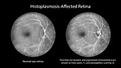 Retina affected by ocular histoplasmosis syndrome, illustration