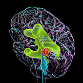 Brain tumour causing hydrocephalus, illustration