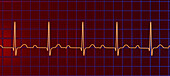ECG displaying first degree AV block, illustration