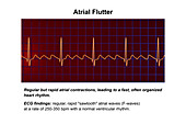 ECG in atrial flutter, illustration