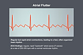 ECG in atrial flutter, illustration