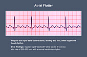 ECG in atrial flutter, illustration