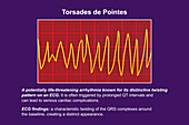 ECG displaying Torsades de pointes rhythm, illustration