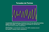 ECG displaying Torsades de pointes rhythm, illustration