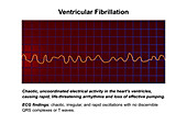 ECG in ventricular fibrillation, illustration