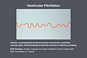 ECG in ventricular fibrillation, illustration