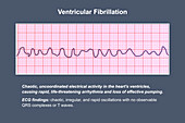 ECG in ventricular fibrillation, illustration