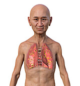 Lung histoplasmosis, illustration