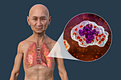 Lung histoplasmosis, illustration