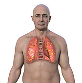 Lung histoplasmosis, illustration