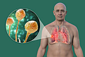 Man with lung mucormycosis lesion, illustration
