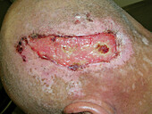 Scalp ulcer due to itching