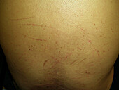 Scratches in patient with jaundice