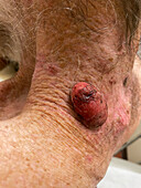 Squamous cell carcinoma