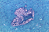 Feline brain tissue infected by Cryptococcus neoformans fungus, light micrograph