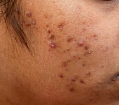 Acne vulgaris